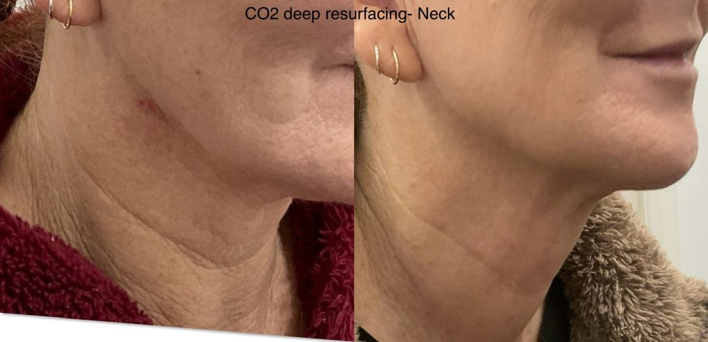 Co2-Laser-Skin-Tightening