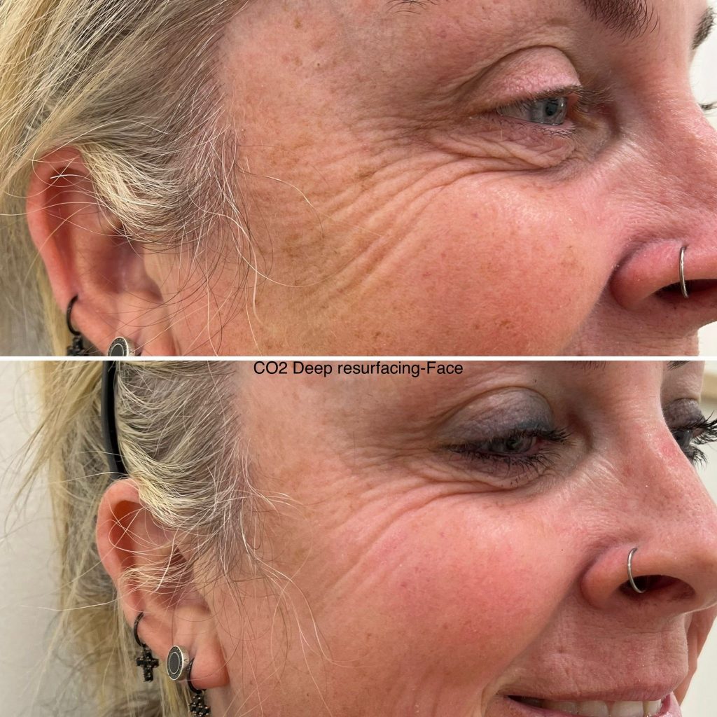 Co2-Laser-Skin-Tightening