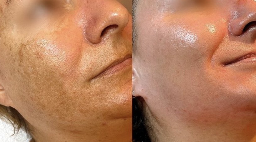 Cosmelan-Pigmentation-Treatment