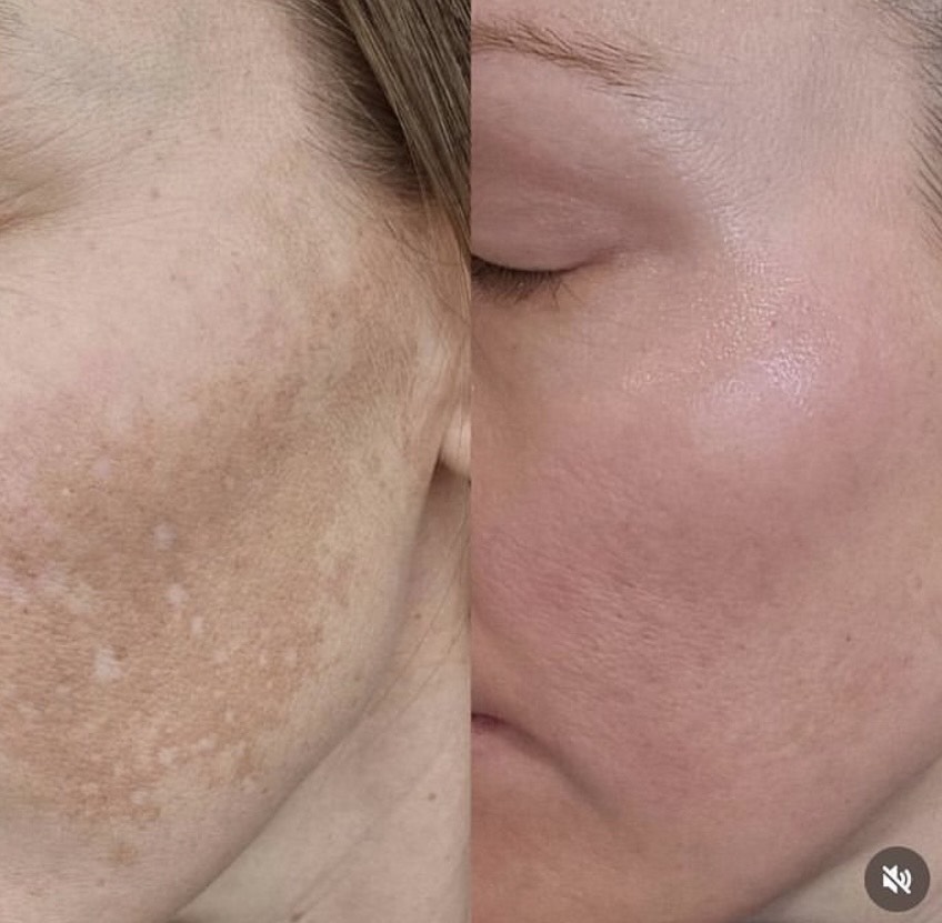 Cosmelan-Pigmentation-Treatment