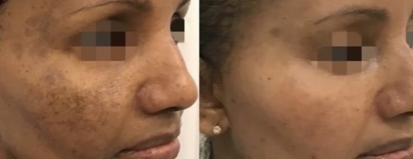 Cosmelan-Pigmentation-Treatment