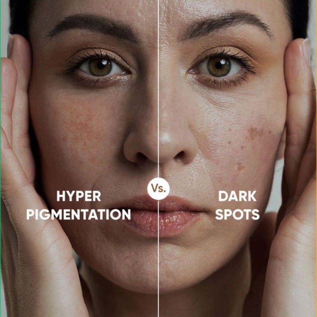 HYPERPIGMENTATION-AGE-SPOTS