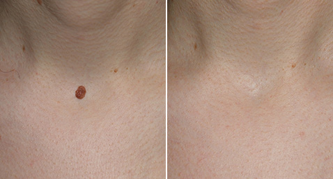 Mole removal skin tag removal