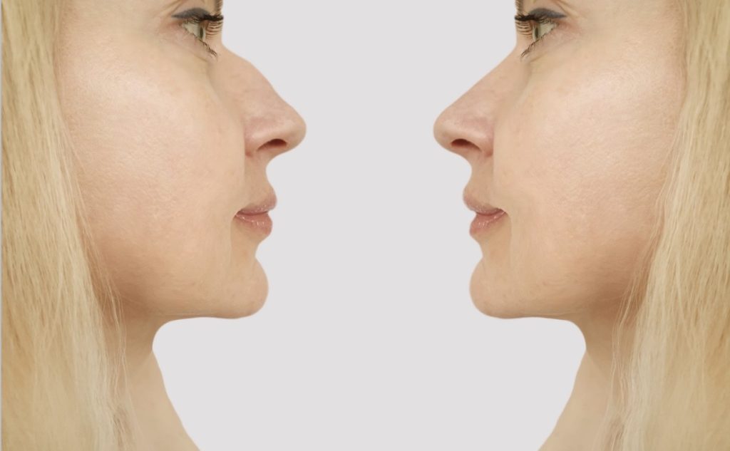 Nose-Lift-PDO-Threads