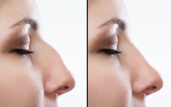 Nose-Lift-PDO-Threads