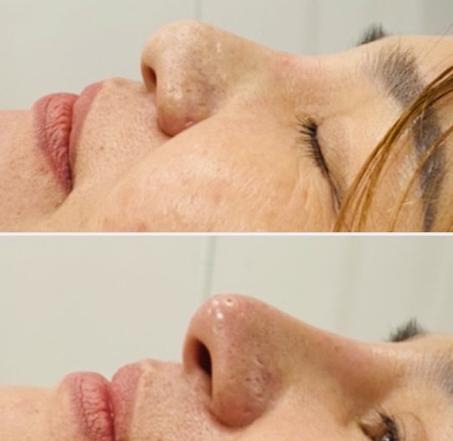 Nose-Lift-PDO-Threads