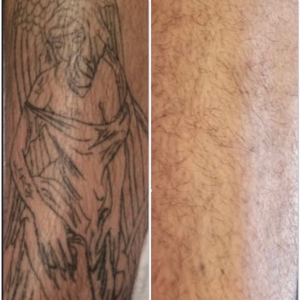 Tattoo removal